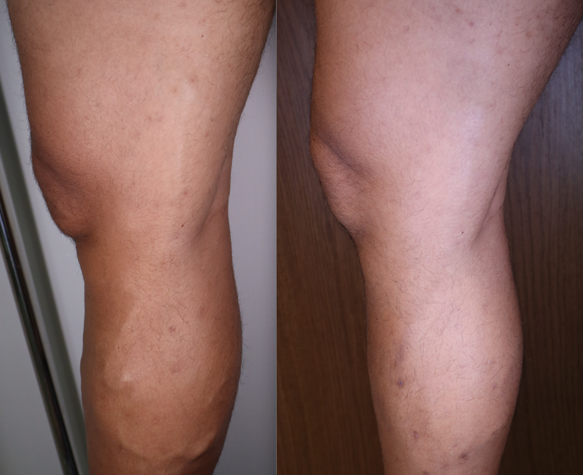 Antes e Depois do Tratamento com Laser Endovenoso – Recuperação Rápida e Resultados Visíveis