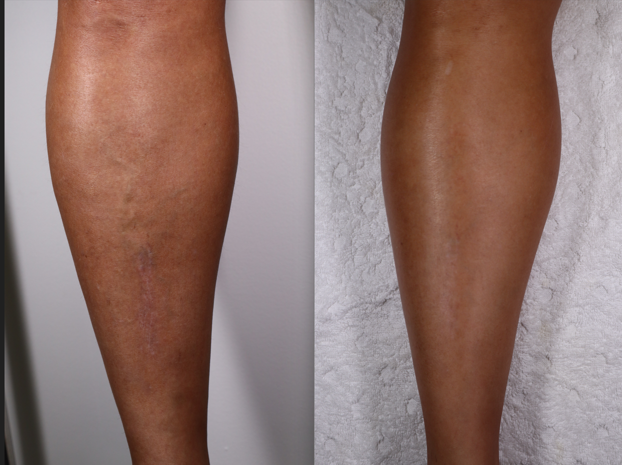 Após o tratamento, observa-se a restauração do fluxo venoso e uma melhora significativa na textura e no aspecto da pele.